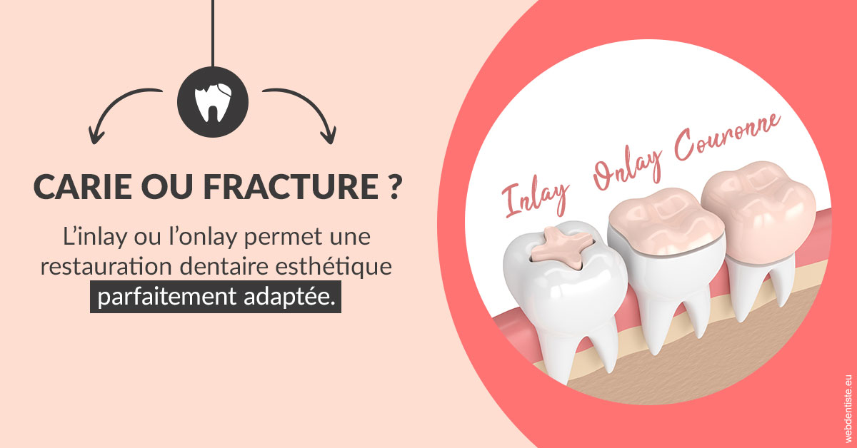 https://dr-curnier-laure.chirurgiens-dentistes.fr/T2 2023 - Carie ou fracture 2
