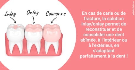 https://dr-curnier-laure.chirurgiens-dentistes.fr/L'INLAY ou l'ONLAY 2