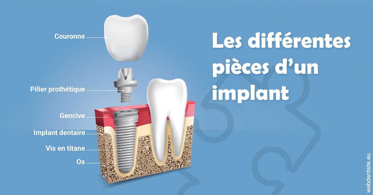 https://dr-curnier-laure.chirurgiens-dentistes.fr/Les différentes pièces d’un implant 1